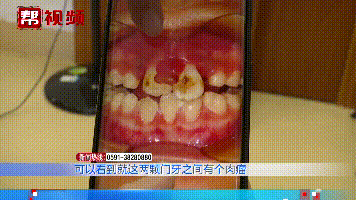 牙齿|为矫正牙齿，孩子的牙根上被装了这个东西，结果牙齿差点不保