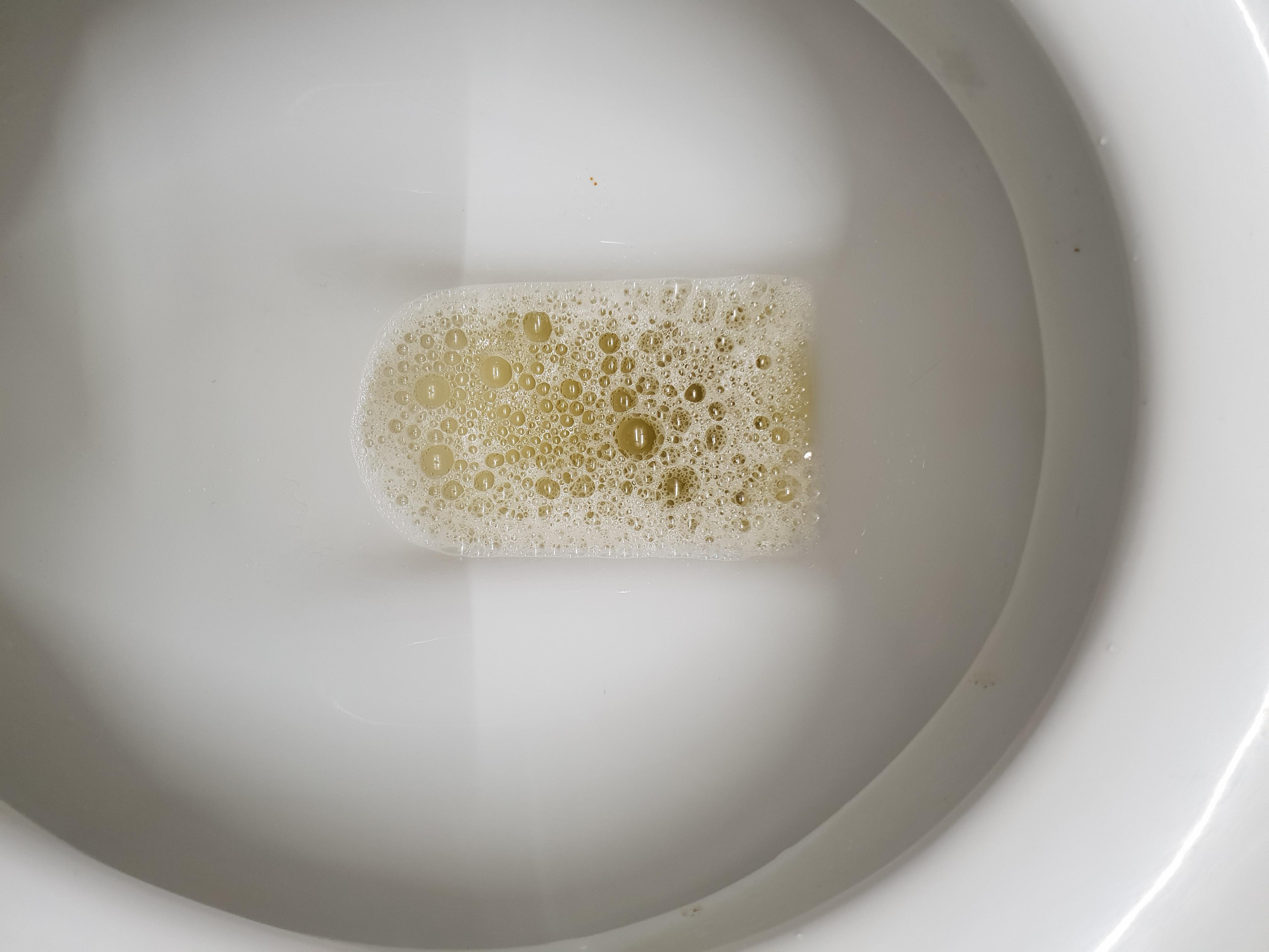 肾衰竭|尿液若有这4种异常改变,当心肾衰竭来临!及时就医很重要