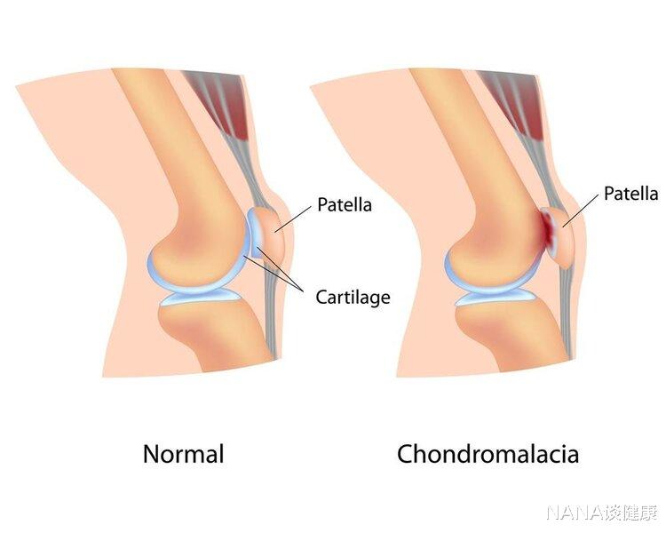 疾病|走路时，膝盖突然“软”一下，是咋回事？本文告诉你真相，要留心