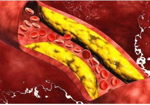 北庭美体健康圈|多走路可以降血脂？医生提醒：做好这4件事或比走路有效