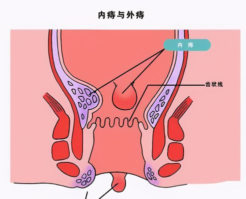 长寿|得了痔疮怎么办？老中医自用的“七分养三分治”疗法，快速消除痔疮肉球！
