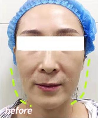 面部提升王小民教授|面部拉皮王小民教授：你要悄悄逆生长，然后惊艳所有人！