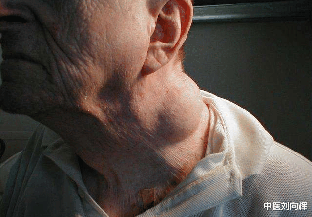 中药|消肿、散结没办法?四味低调、力量大的中药,帮你改善