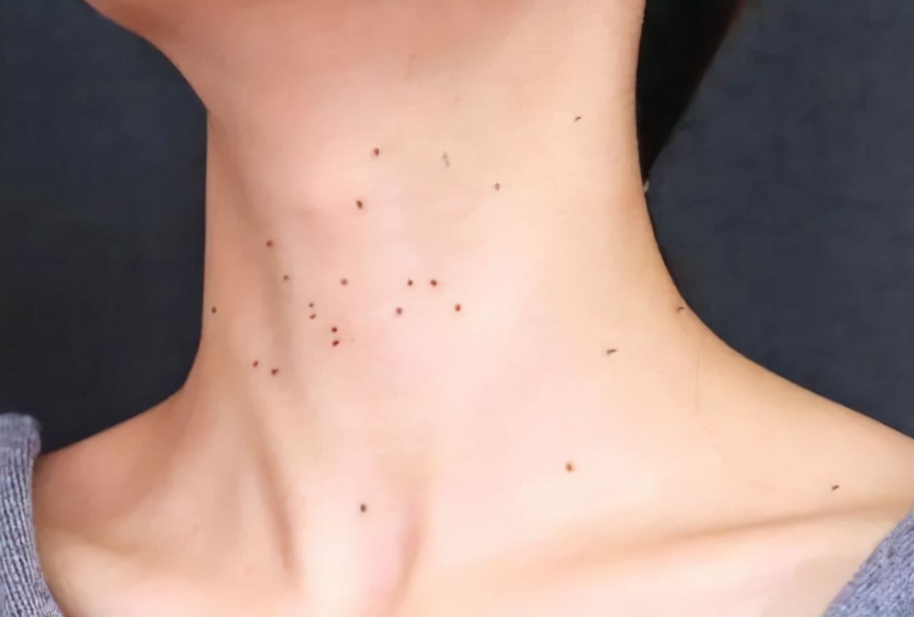 医生|37女子意外染上HPV,2个月后疣体满脸,医生感叹:一定要重视,晚了毁容