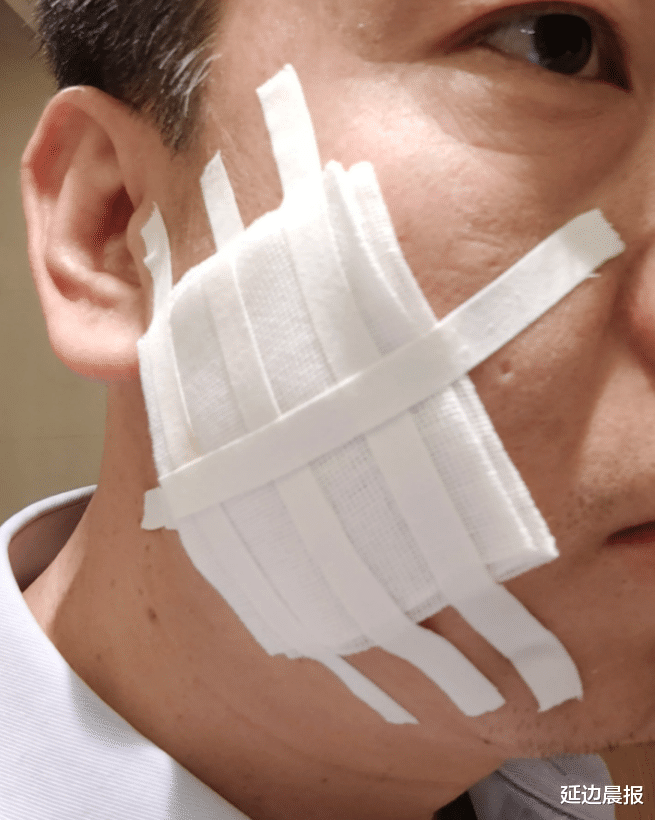 延边晨报 西安男子自曝被高管烟头烫脸：他说疼才长记性，不要\＂刺头\＂员工