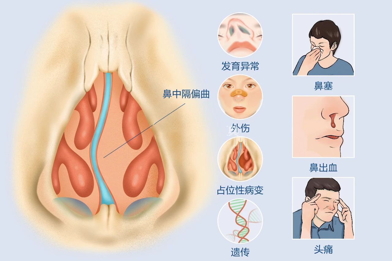耳鼻喉申医生 鼻中隔偏曲如何矫正？其手术的价值和必要性！