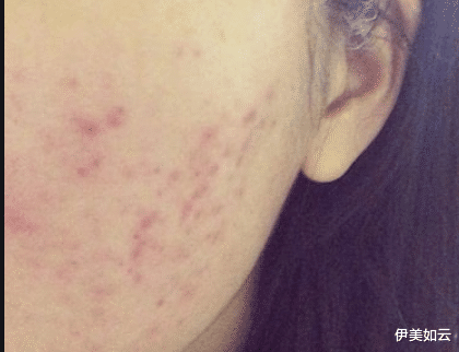 伊美如云|消除痘印黑色素，你必须知道这几件事