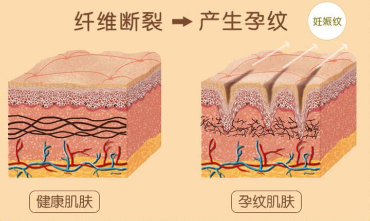 樱桃妈咪|妊娠纹大作战!做好预防工作,妇产医生都夸的“零孕纹”肚皮!