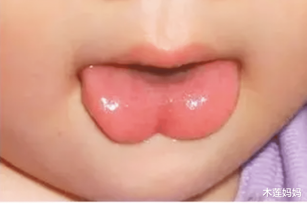木莲妈妈|贵人开口迟?孩子的“舌头形状”,会影响说话的能力,家长别大意