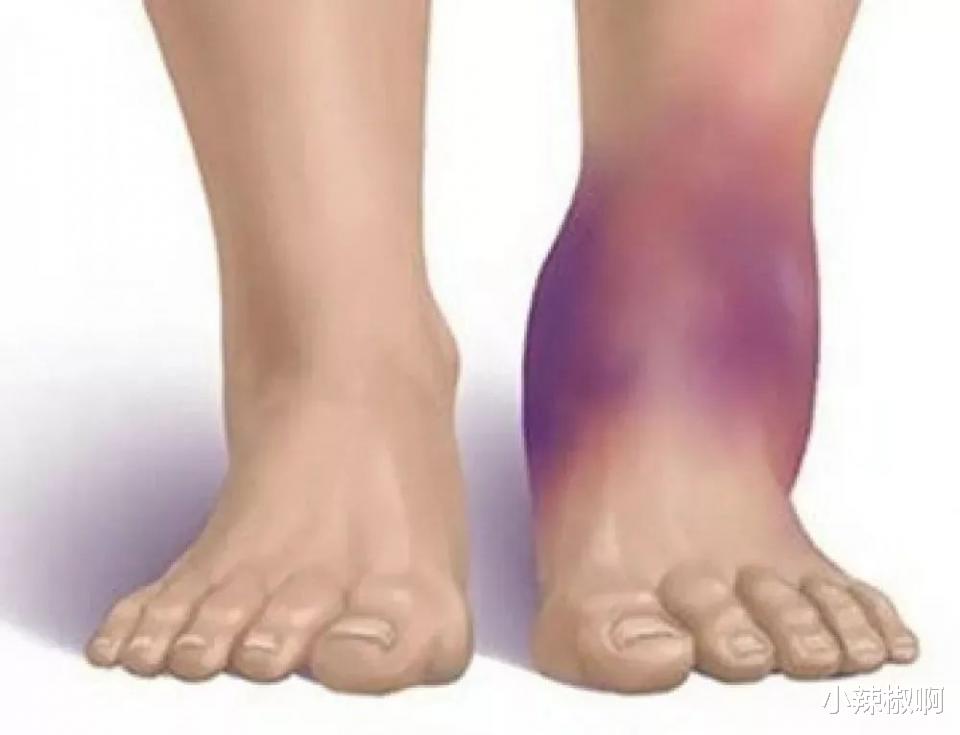 饮食|哪些饮食有抗炎症的作用？怎样去发现慢性炎症的蛛丝马迹？——上