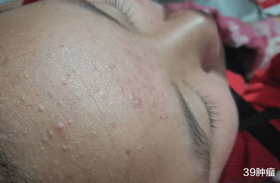 39肿瘤 21岁女子每天一碗银耳粥，查出肝癌，医生：或比酒精还伤肝，趁早远离
