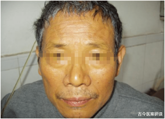 古今医案研读|60岁夫妻相继查出肝癌，2个月后去世，医生：冰箱中2种食物或是“罪魁祸首”，要注意