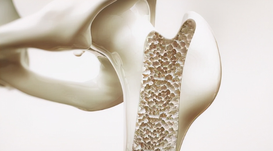 骨质疏松|骨质疏松不能吃玉米?医生:不想骨骼被“挖空”,2种食物劝你少吃