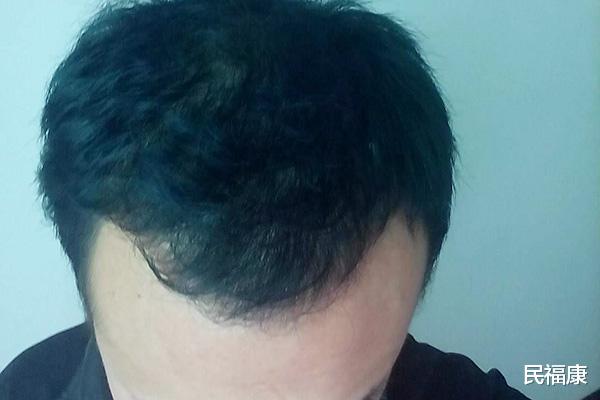 脱发|头发多久洗一次比较好？天天洗头会不会导致脱发？