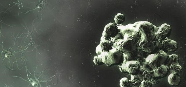 朊病毒 致死率100%的病毒，感染者在癫狂中死去，是上帝对同类相食的惩罚