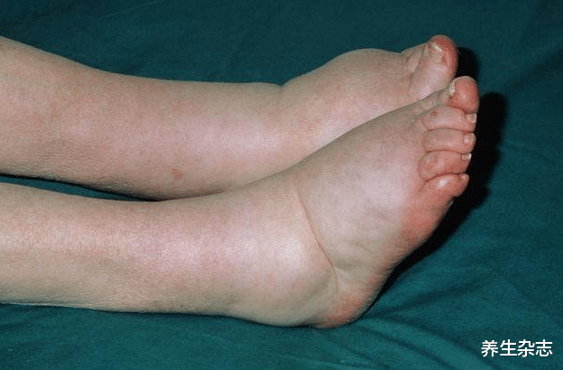 尿酸|你的肾距离“衰竭”还有多远?医生:身体出现4种异常,尽快检查