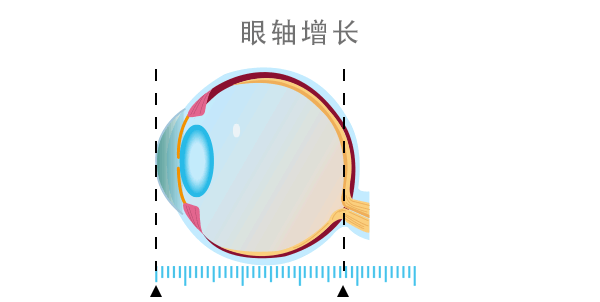 科视E家|【科视眼科】为什么已经成年了，近视度数还在增长？