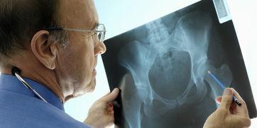 骨质疏松|骨质疏松不能吃小米？医生提醒：不想骨量流失，2类食物更应少吃