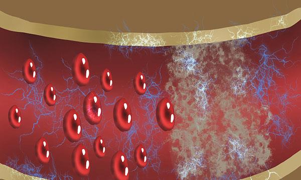冠心病|47岁男子,平时一切正常,冠脉竟堵塞90%,有时相信感觉并不靠谱