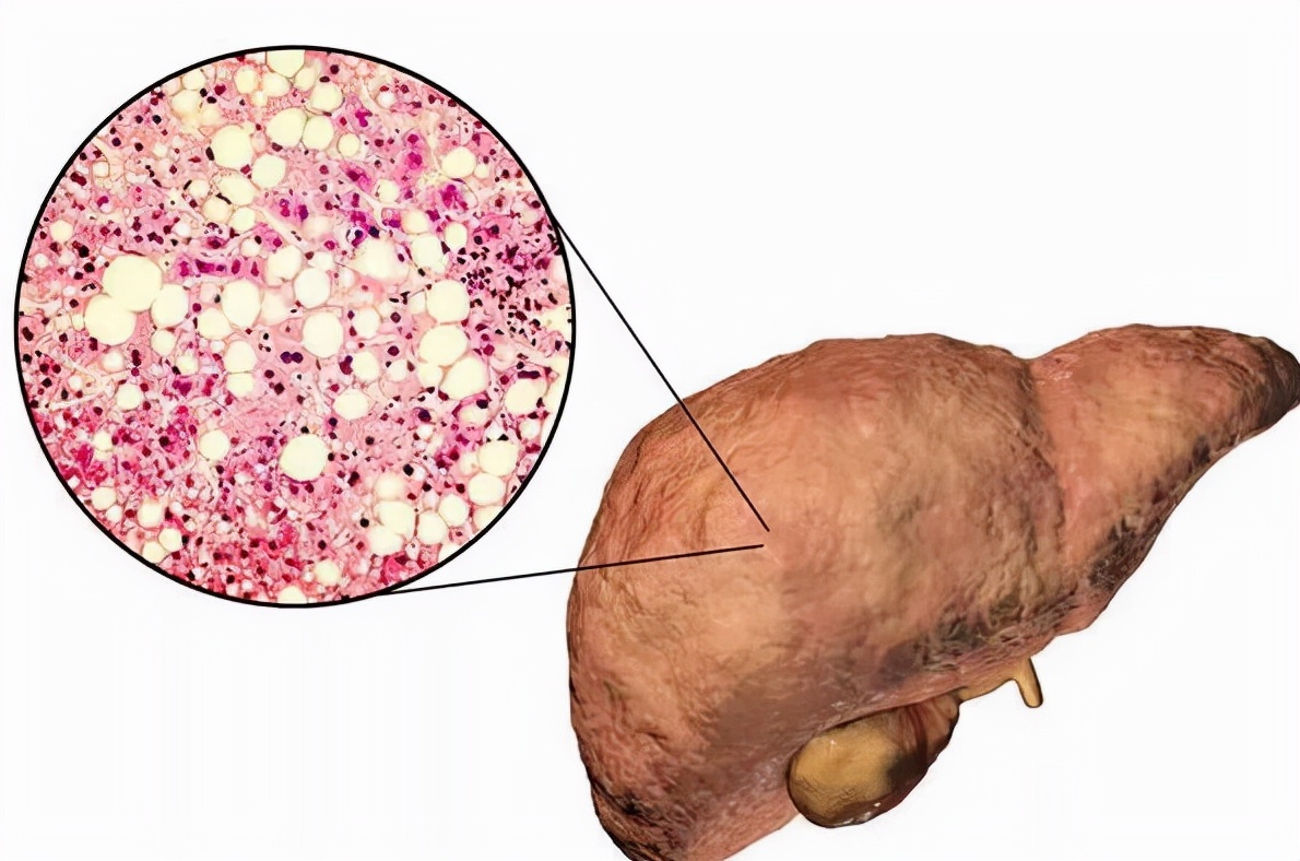 肝脏|肝不好的人，开水中撒一把，帮助肝脏排毒，不出一月，肝渐渐变“软”了