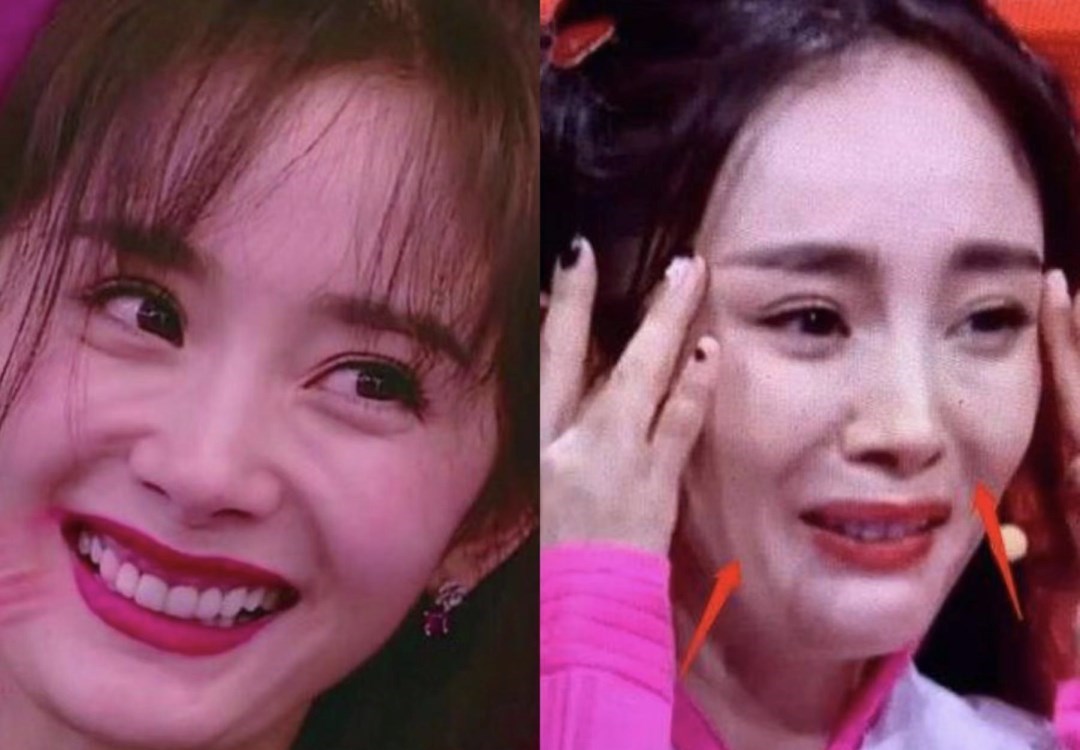 杨幂|女星“削骨”后遗症：杨幂变多边形脸，鞠婧祎脸歪，张萌挂不住肉