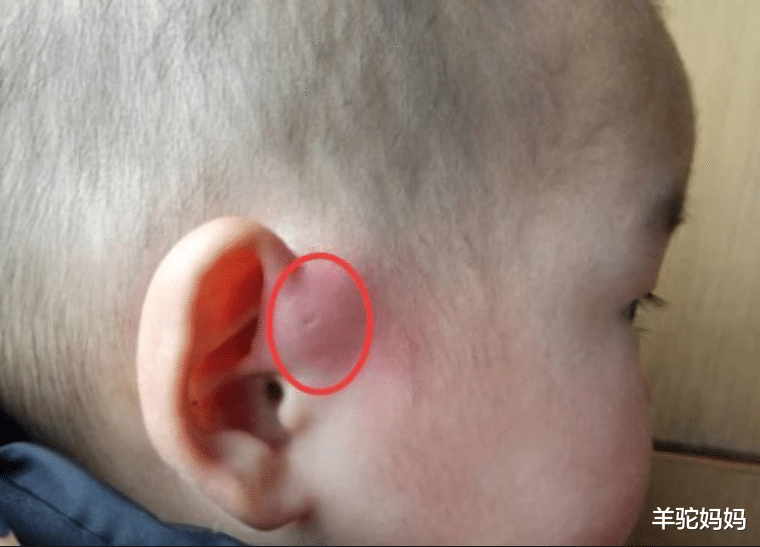 羊驼妈妈|为啥宝宝耳朵旁会有“小眼”?医生通常不说明,新手父母要了解