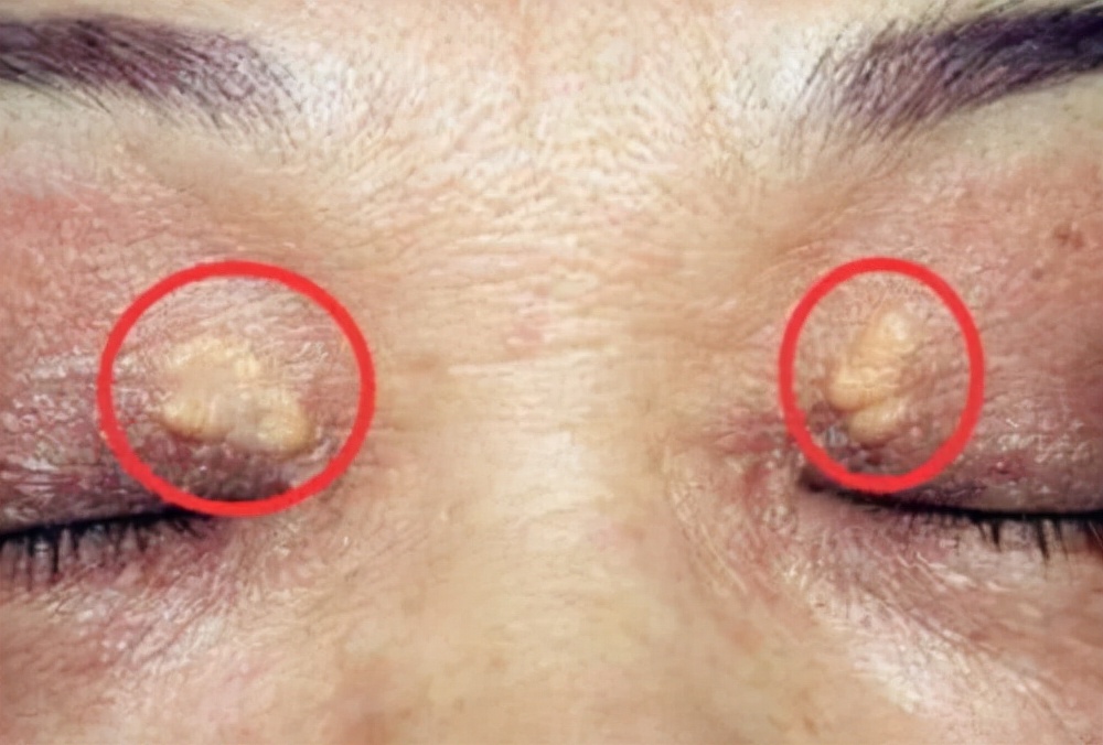 高血脂|“刮油机”登场，血液黏稠如粥又如何，照样将血液稀释干净