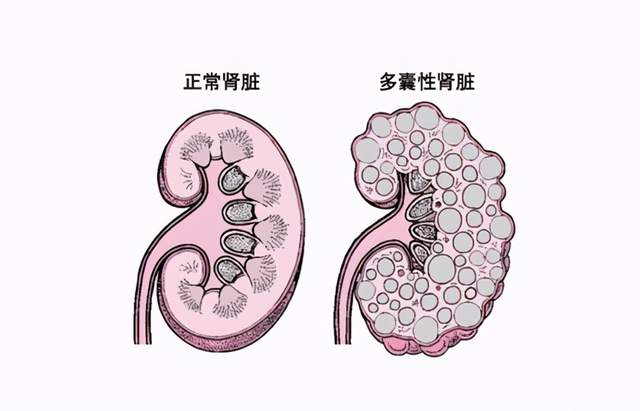 经络穴位理论敷熨|多囊肾不是不治之症！囊肿可以缩小，肾友们加油