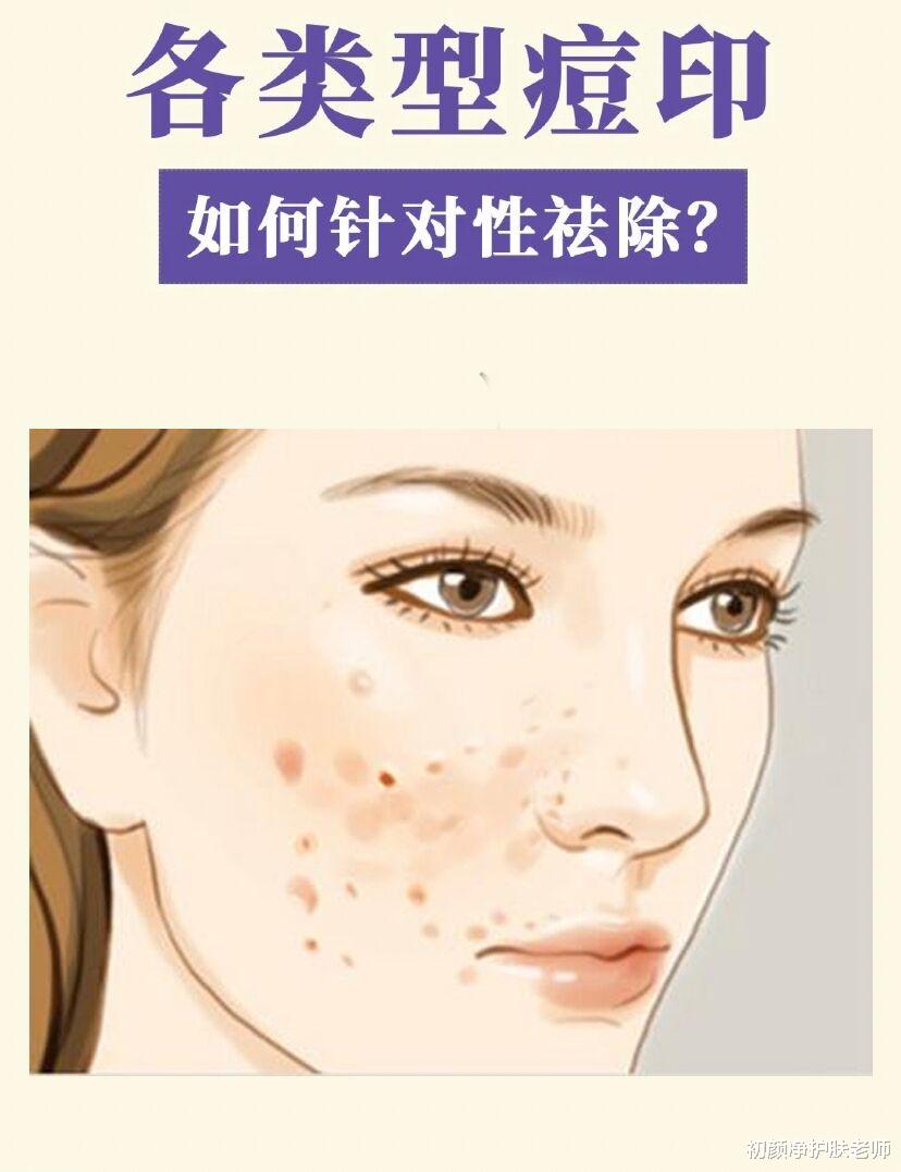 初颜净护肤老师 痘印真的别乱去！先看看这些注意点吧！