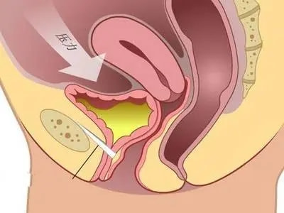 香蕉|卫生部权威发布: 红霉素软膏跻身治疗痔疮特效药！每天成本1毛钱