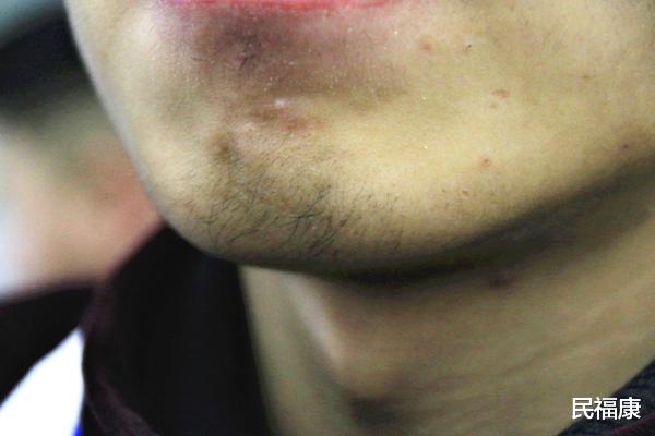 荷尔蒙|胡子长的快，是什么原因导致？刮胡子太麻烦，是否能直接拔掉？