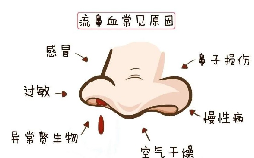 小儿推拿杨晓|小儿推拿杨晓：秋天孩子老流鼻血是怎么回事？怎样处理？如何预防