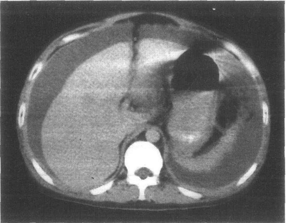 毛囊炎|老年常有腹胀不适的感觉，那么这是为什么呢？要警惕并发症