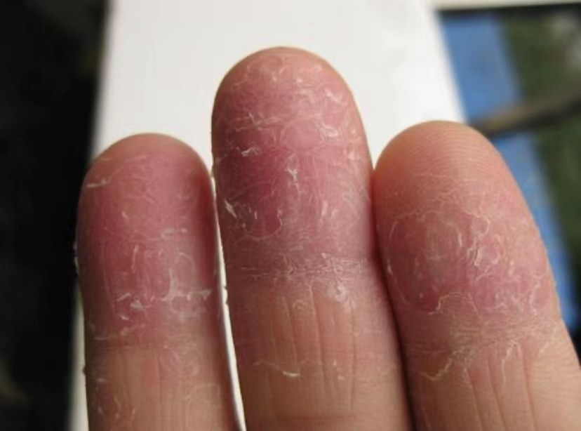 静脉血栓形成|几块钱一瓶的维生素C，是6种病的“药”，不吃就亏了