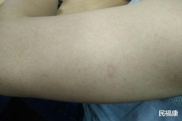 瘙痒症|上了年纪的人，皮肤总是痒，而且越挠越痒，怎么回事？