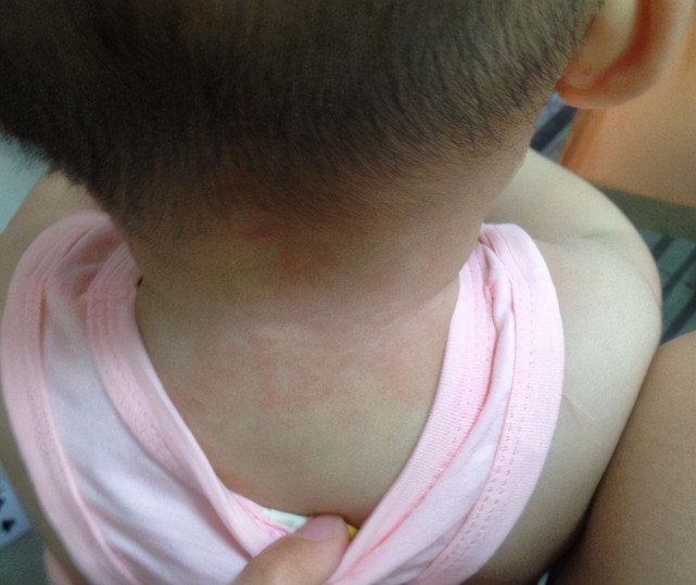 京妈说|为啥天热宝宝爱长痱子?这几件事家长别做错,不然反复长让娃遭罪