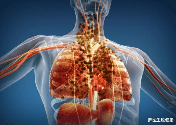 罗医生说健康|肺部“清道夫”找到了，不是银耳，饭后敞开吃，肺部干净到底