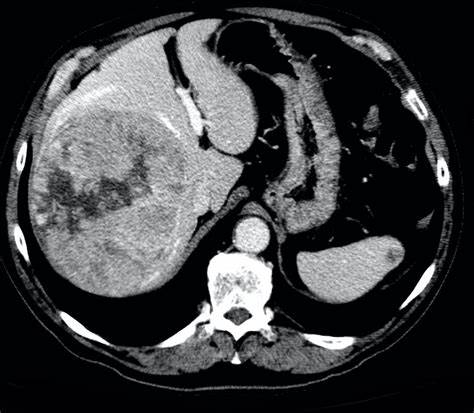 宫颈癌|听说，乙肝能治愈啦？医生辟谣：可以临床治愈，但没那么简单