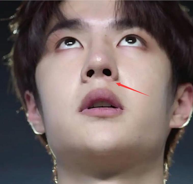 王一博|王一博疑似整容失败？鼻梁乌青发黑，被质疑刚取了假体？