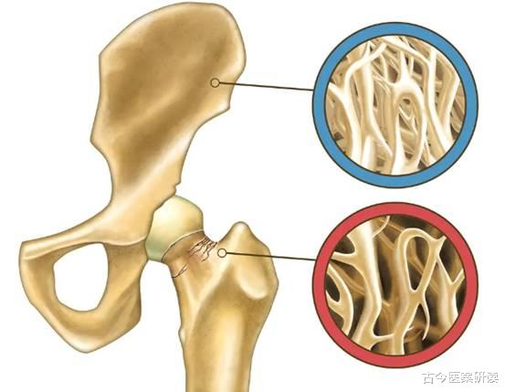 医生|吃一次相当于吃2碗盐,很多人戒不掉,医生:骨头或因此烂成“渔网”