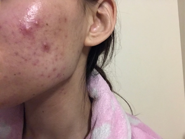 大衣 冬季爆痘不知道怎么办？小仙女们看过来