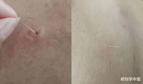 帮你学中医|肛门瘙痒者，五个穴位下挑出“白线”！这种民间疗法，学习一下挺好