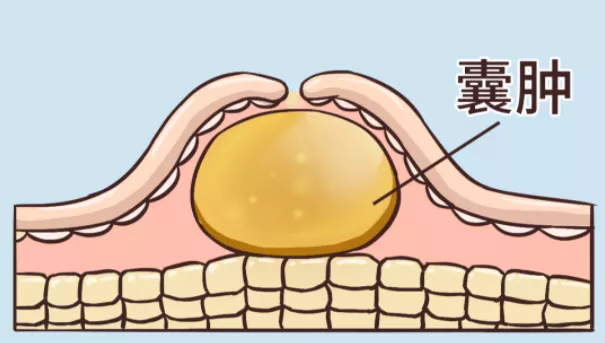 体检|体检查出囊肿，会变成癌么？要切除么？