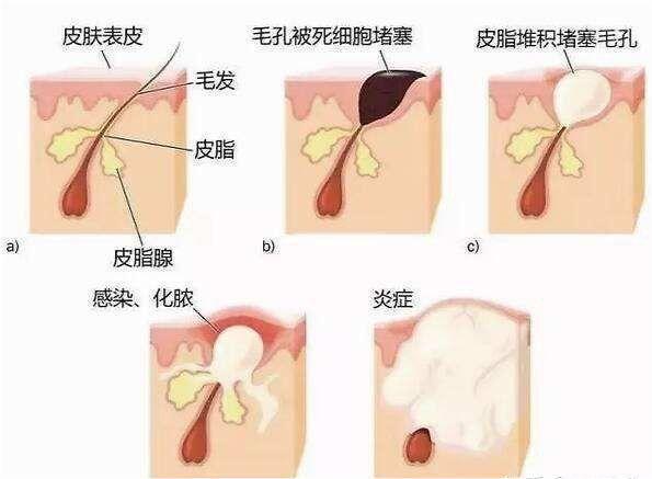 螨虫 脸洗“不干净”，用再贵的护肤品也是白费，你的洗脸方法对了吗？