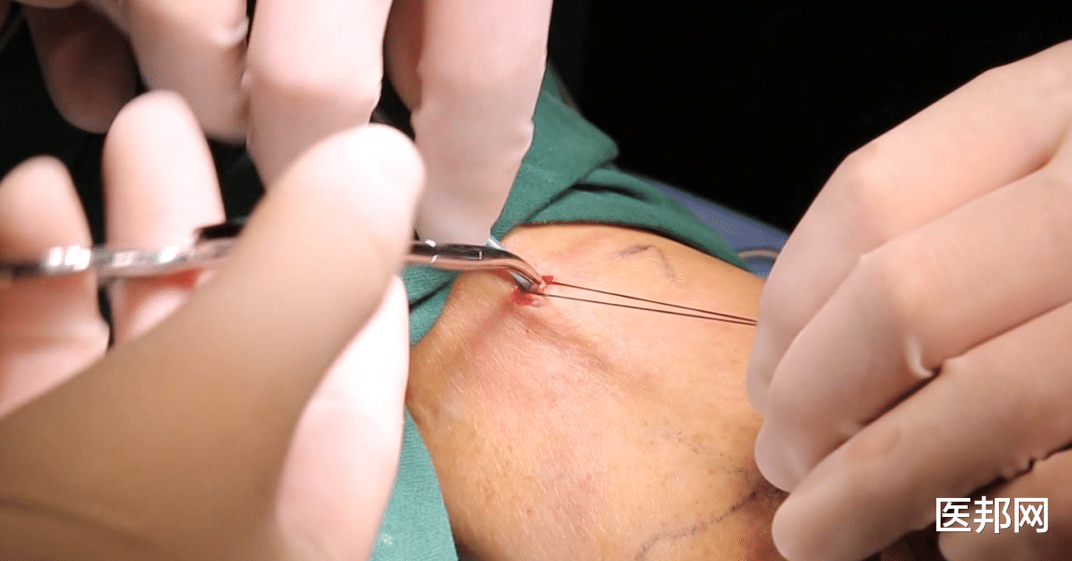 静脉曲张|可以治愈静脉曲张的唯一方法,也有微创了,最佳治疗时机别错过
