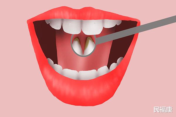 洁牙|洗牙好不好？浅谈洗牙的利与弊，多久洗一次合适？