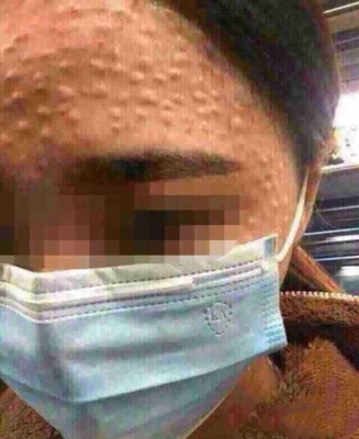 小玉护肤|深度剖析：水光针和长痘之间的某些关联因素!