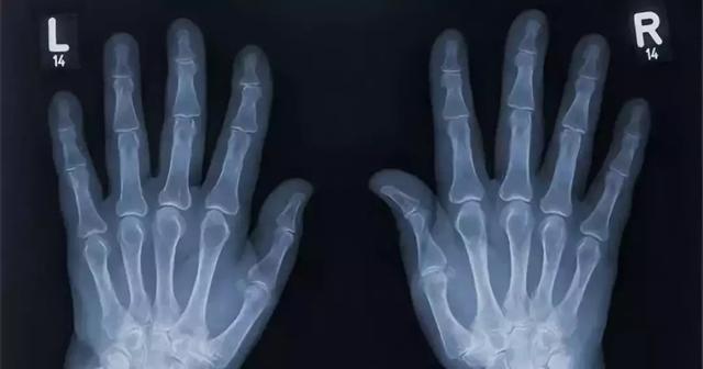 医生|掰手指50年，这位美国医生只为证明一件事。