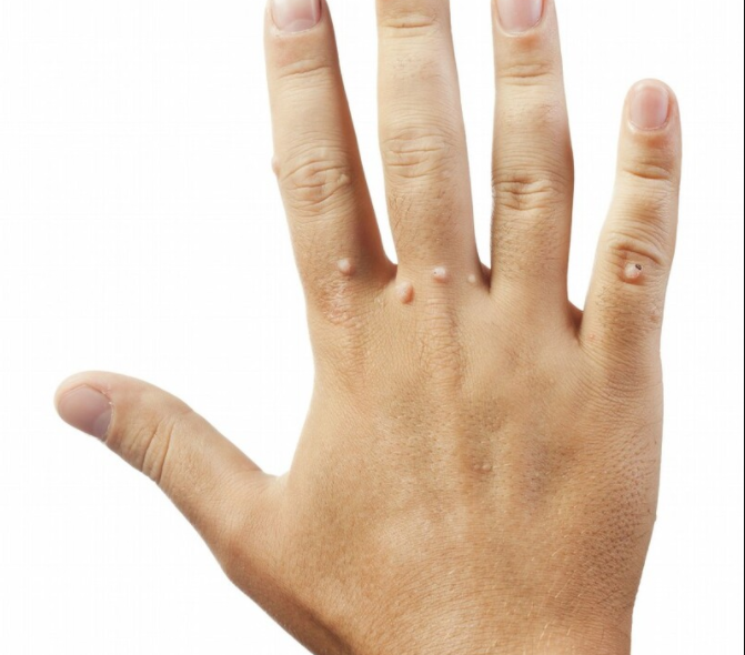 流鼻血|皮肤上有这3种变化，恭喜你被HPV“看上了”，做到这2事就能避免