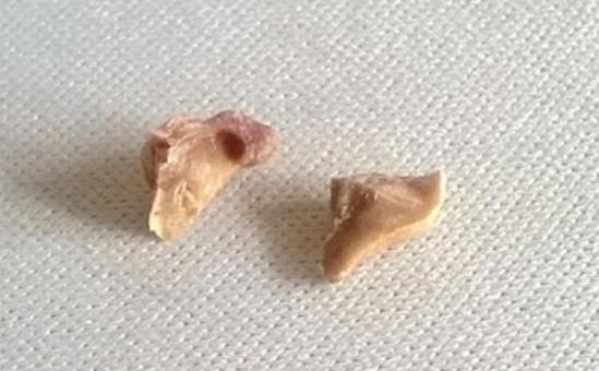 舜网 牙缝里抠出的石头，臭烘烘让人尴尬，小妙招，牙垢悄悄掉下来